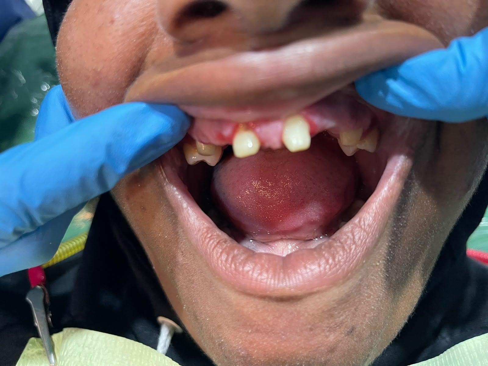 Prótesis dental, antes del tratamiento