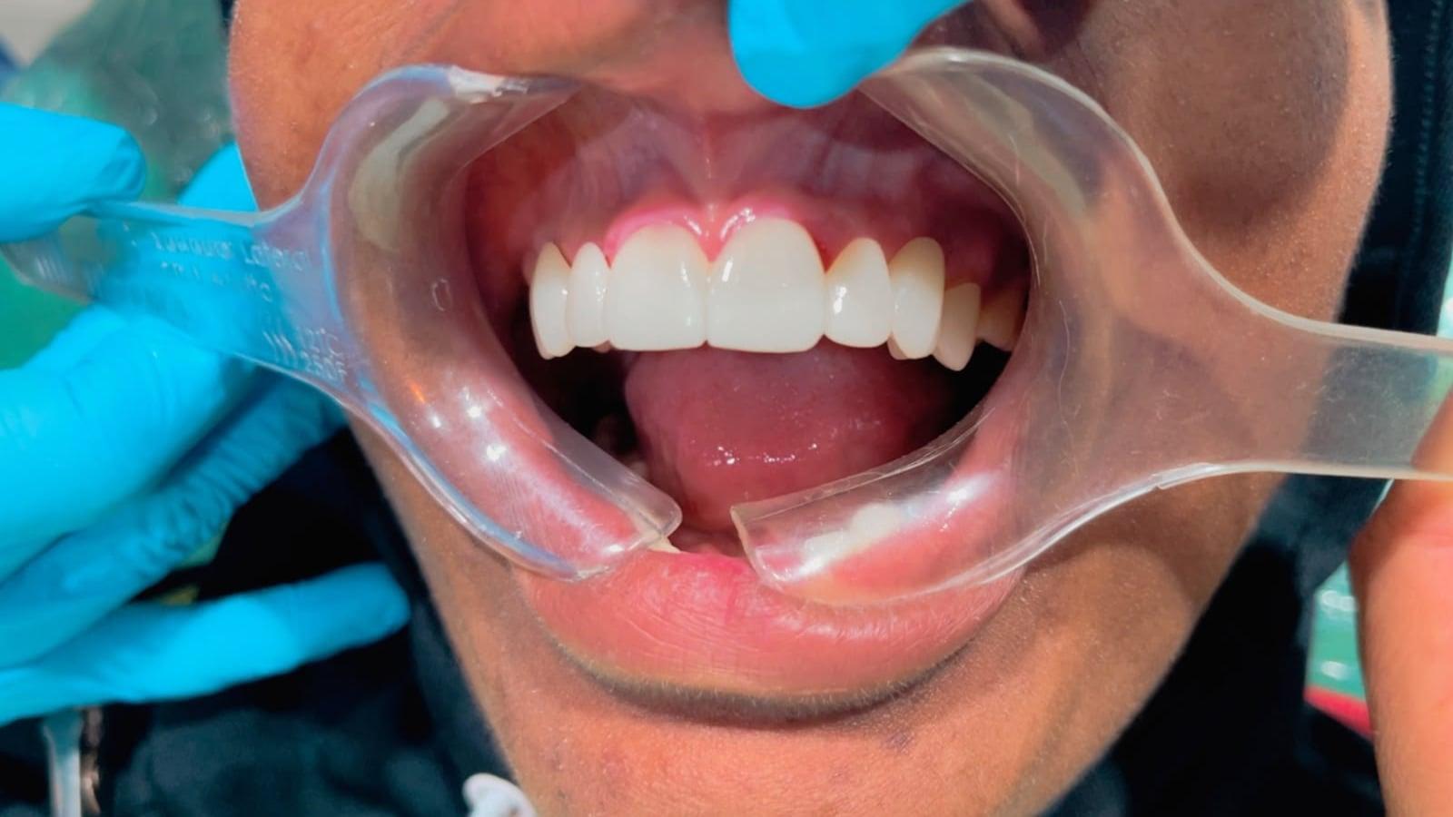Prótesis dental, después del tratamiento