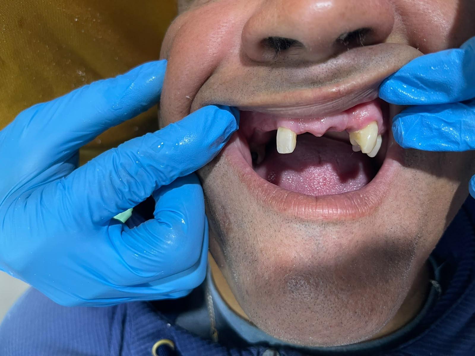 Prótesis dental, antes del tratamiento