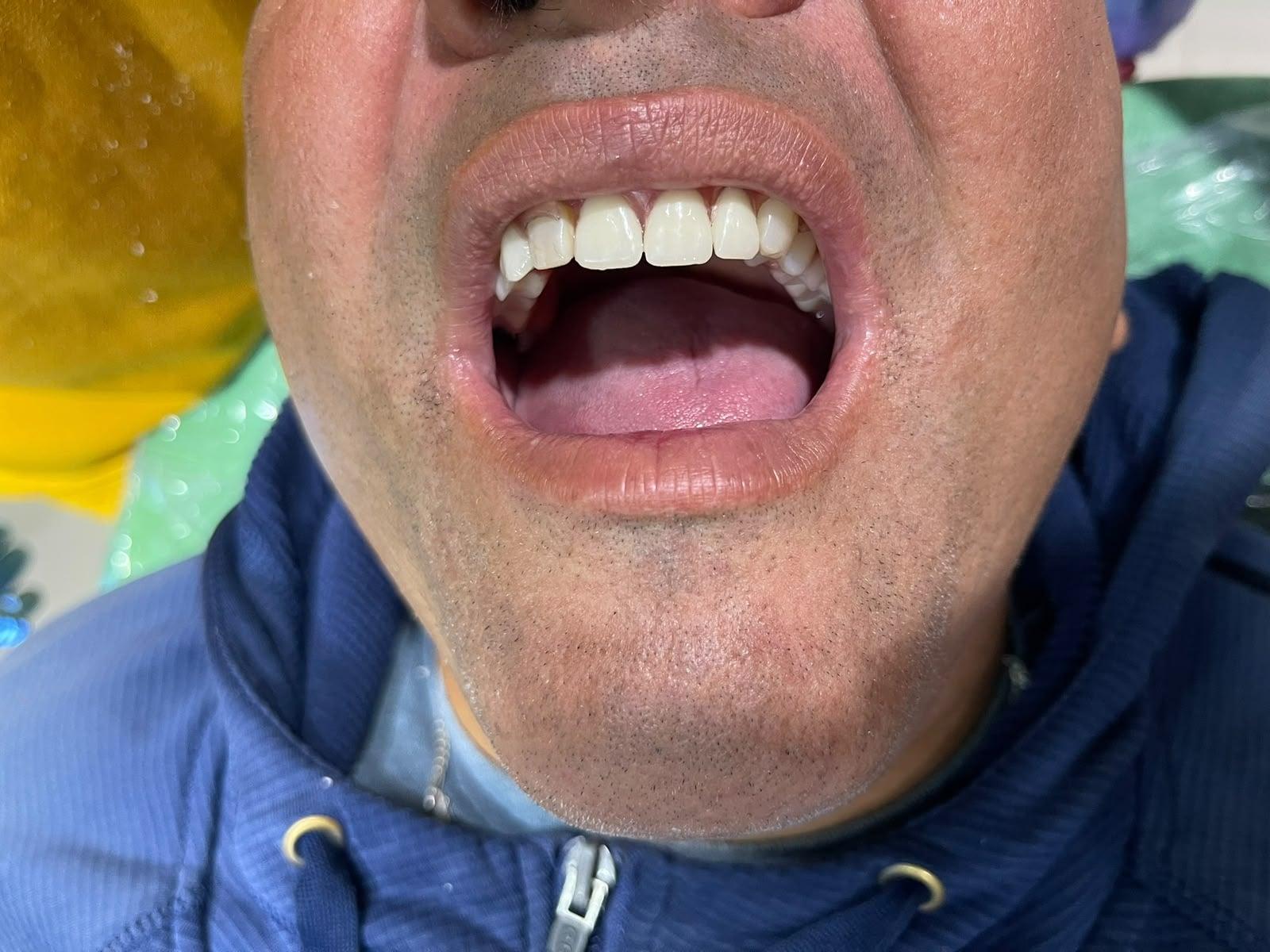 Prótesis dental, después del tratamiento